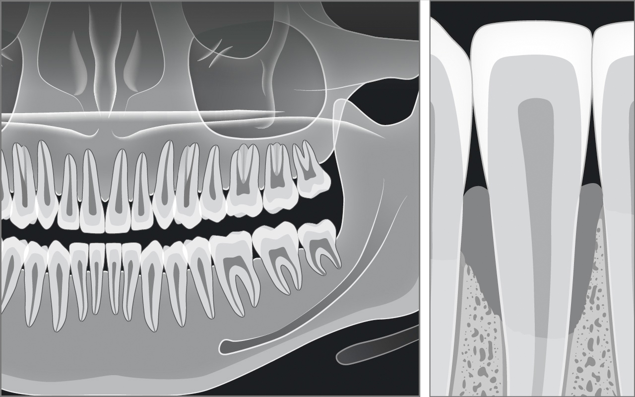 Résultat radiographique