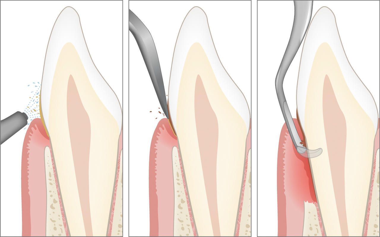 Nettoyage professionnel des dents