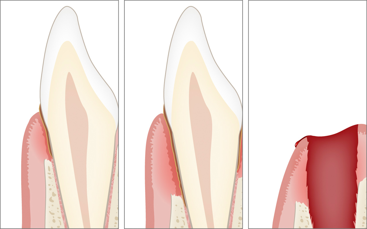 Autres conséquences : perte osseuse, poches gingivales et perte de dents