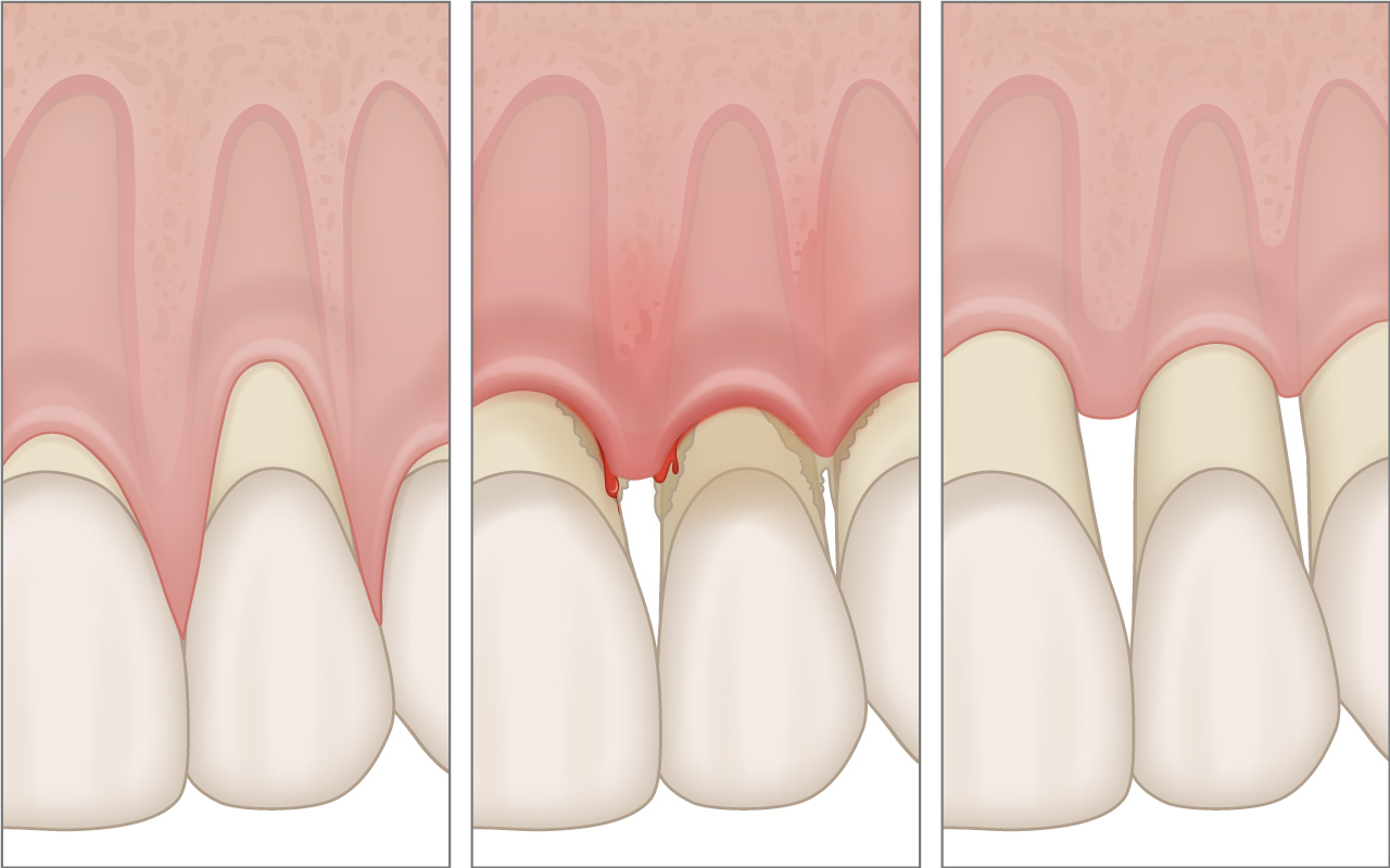 Attention : la récession gingivale n’est pas toujours une récession gingivale